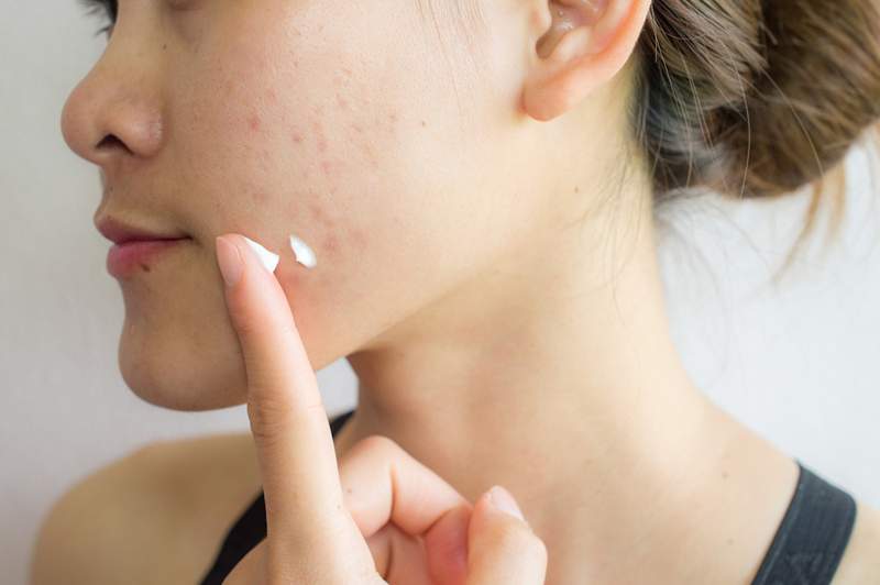 De 5 meest voorkomende vragen DR. Pimple Popper gaat over acne