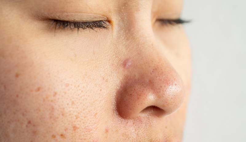 Derms az Accutane-t hívja 'a legközelebbi dolognak, hogy gyógyítsuk az acne-here-t