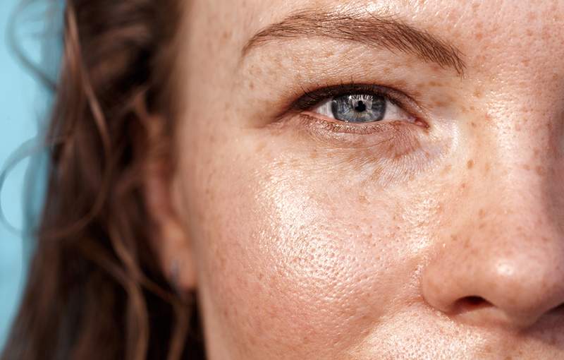 Undereye Filler baru saja disetujui oleh FDA-Here What Derms Want You To Know