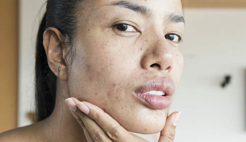 Retinol Purge 101 Segala -galanya Ahli dermatologi mahu anda tahu