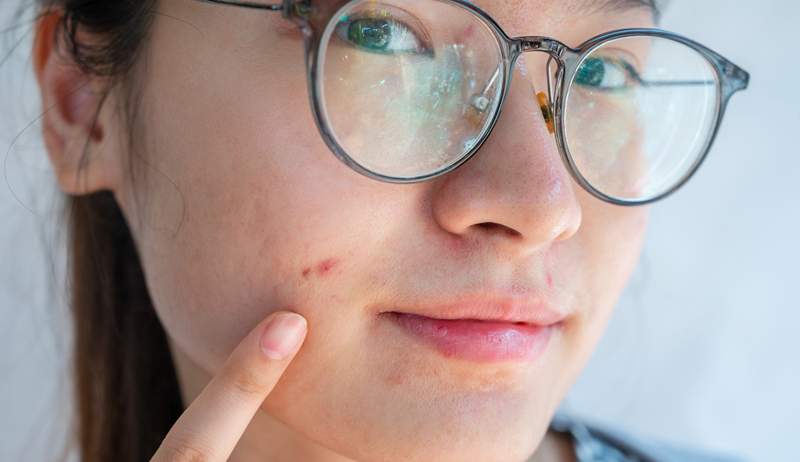 5 Dermatologi condividono i loro segreti meglio custoditi per combattere l'acne e lo promettiamo, non hai mai sentito prima