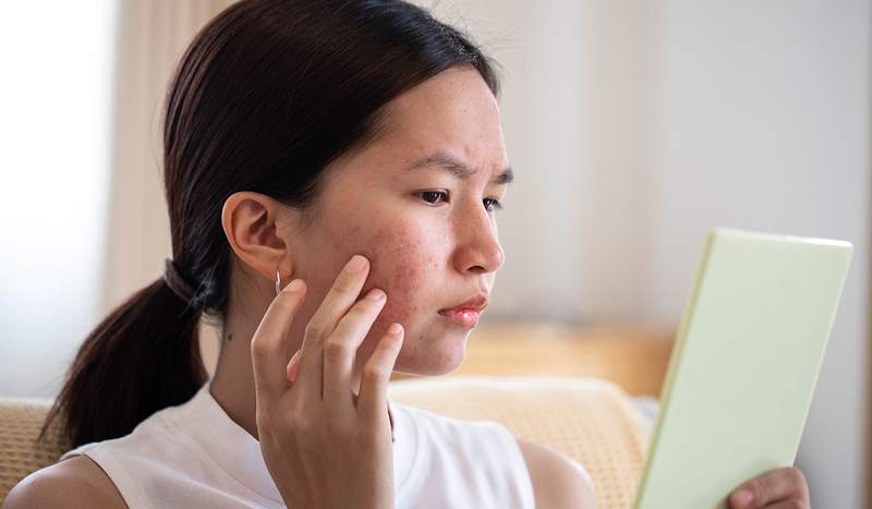 Eu testei este tratamento de acne e as espinhas e evitei fugas em apenas dois dias