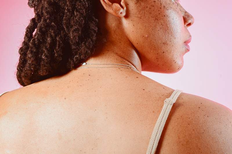 Comment se débarrasser de ces têtes blanches embêtantes, selon les dermatologues