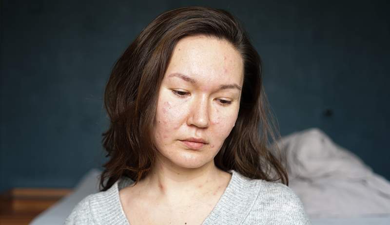 Kunne 'betændelse' være grunden til din acne? Denne hudlæge tænker ja