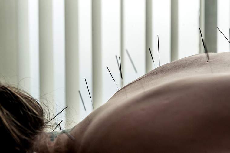 4 lucruri pe care le -am învățat din încercarea de acupunctură pentru prima dată